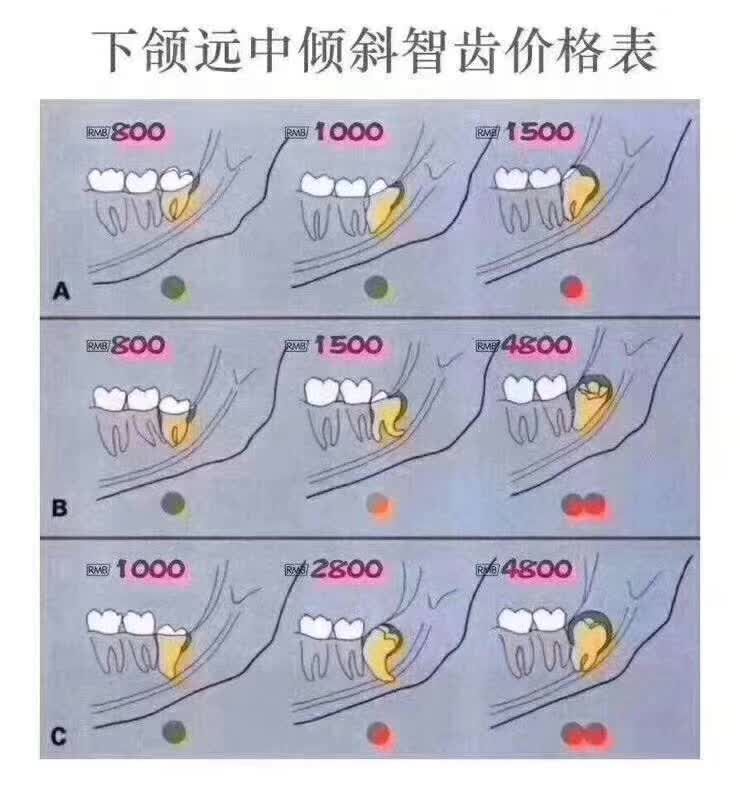 最全智齿形态及拔智齿收费标准