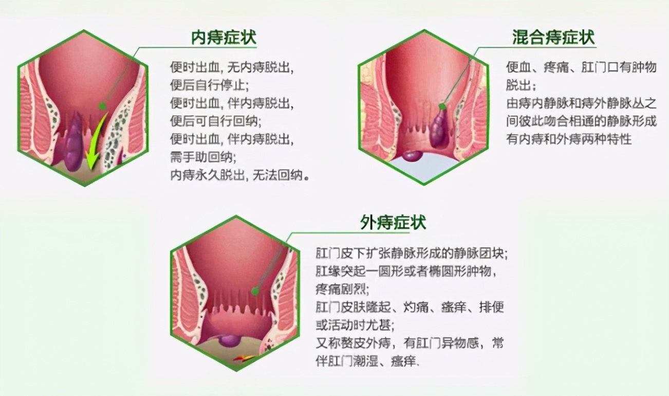 肛门里长了个小肉球是痔疮吗？