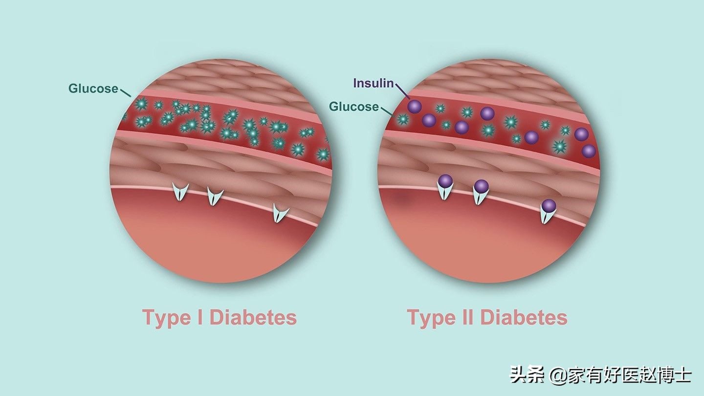 血糖升高，怀疑2型糖尿病？确诊先别急，胰岛免疫筛查别忘记