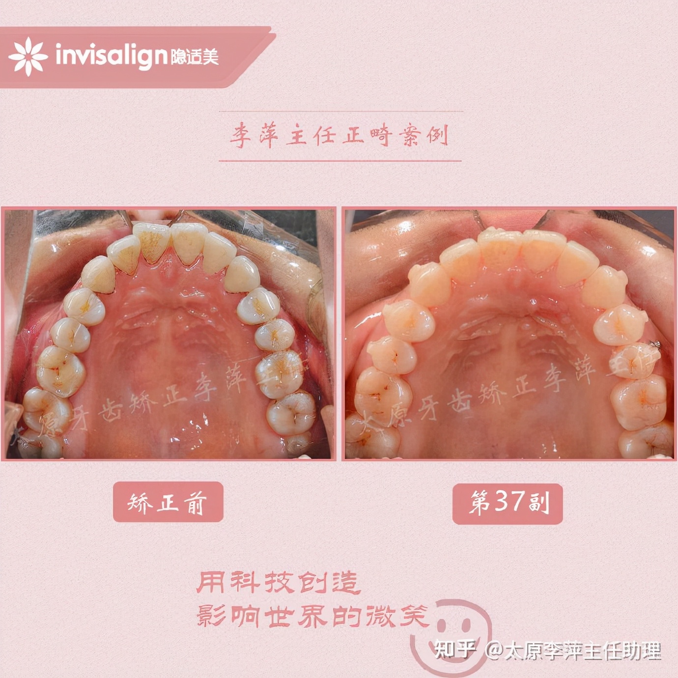 太原牙齿矫正：隐形牙套效果好不好？看这些病例你就知道了