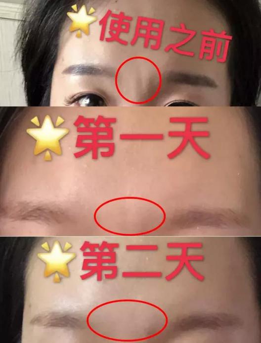 让日本女人夜夜疯狂的神器，法令纹、眉间纹克星！一贴＝10次除皱