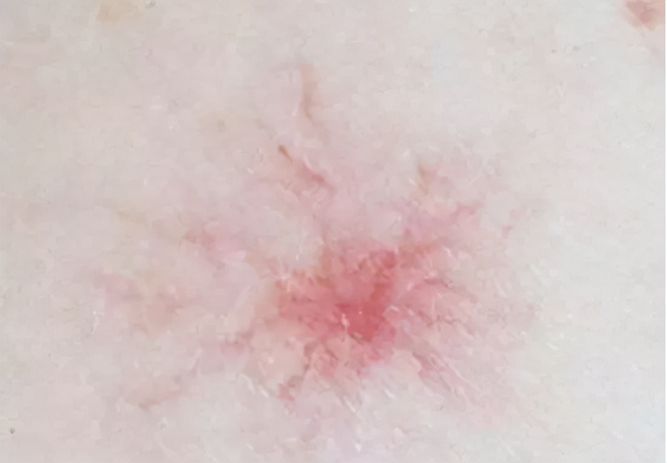 身上出现很多小红点，像小红痣，不痛不痒是怎么回事？