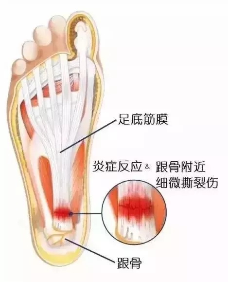 骨科大夫告诉您：脚后跟一踩地就疼？可能和这个病有关