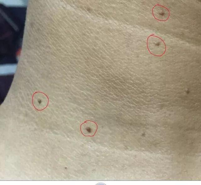 犹如老年斑的扁平疣,严重影响美观,该如何处理?