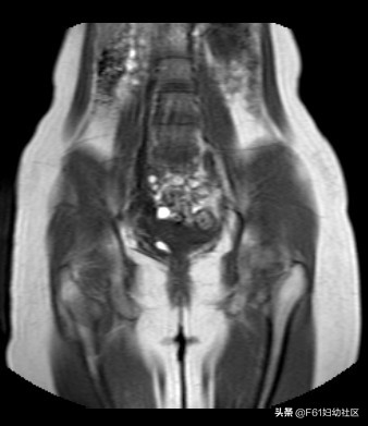 阴道斜隔及图片