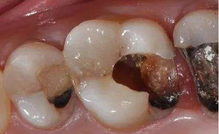 牙齿莫名变黑是为什么?牙上的小黑点该怎么去除?看看牙医怎么说