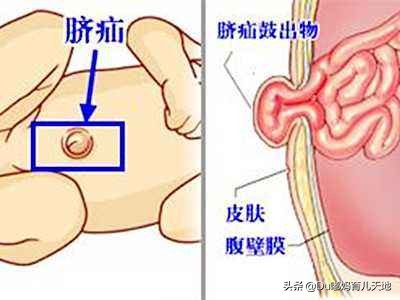 婴儿脐疝怎么护理（婴儿脐疝应该怎么办）