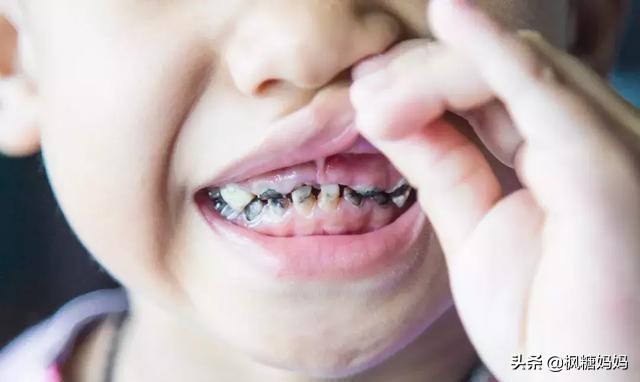 儿童吃糖坏牙恐怖图片(4岁宝宝长10颗蛀牙) - 赤虎壹号