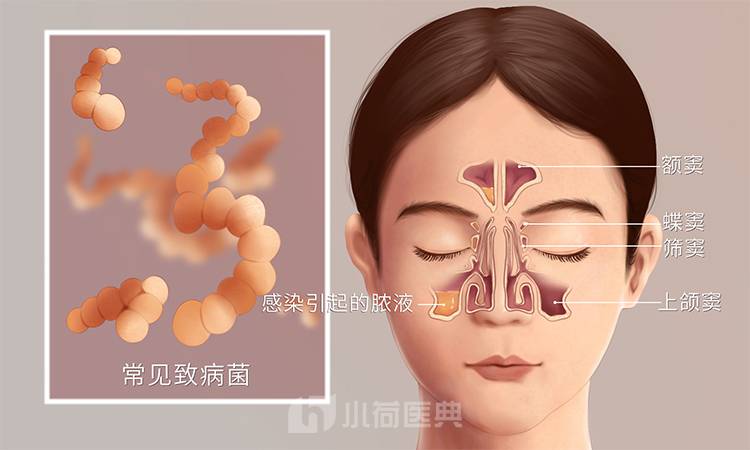 鼻窦炎的位置及症状
