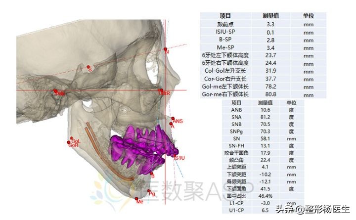 面部轮廓太重要了，明星们做磨骨手术，国字脸变成瓜子脸