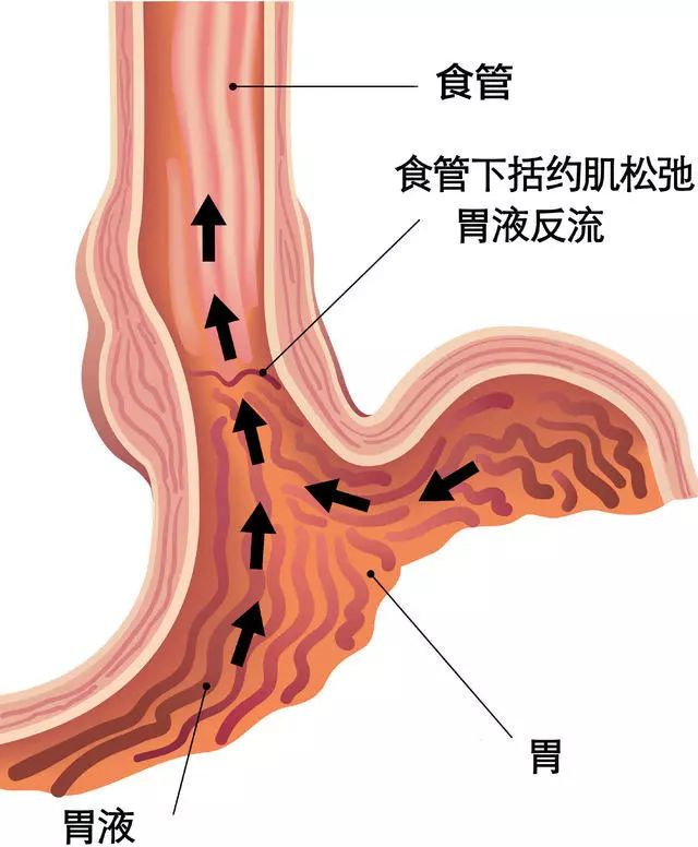 中秋团圆聚会，饭后出现反酸烧心要注意，当心胃食管反流找到你
