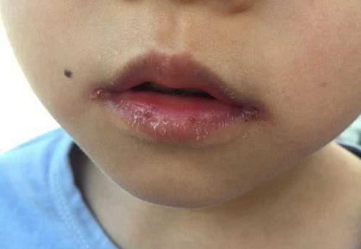 下唇肿胀的儿童会感染脓肿，导致口腔溃疡 库存照片. 图片 包括有 关心, 慢性, 溃疡, 人员, 特写镜头 - 210807918