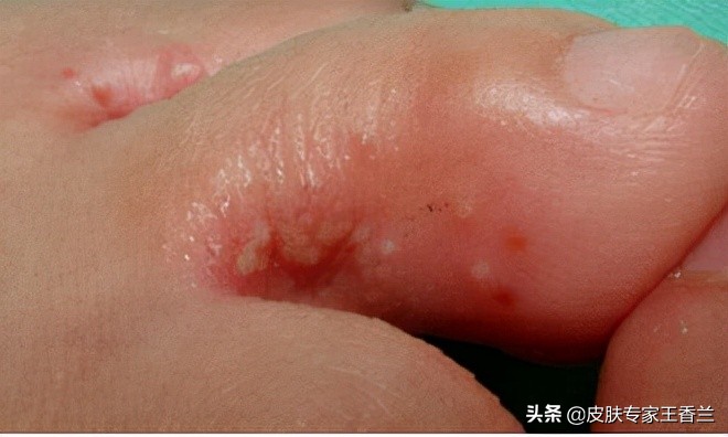 致病菌:浅表皮肤真菌感染是引发足癣的病因,主要病原菌有红色毛癣菌