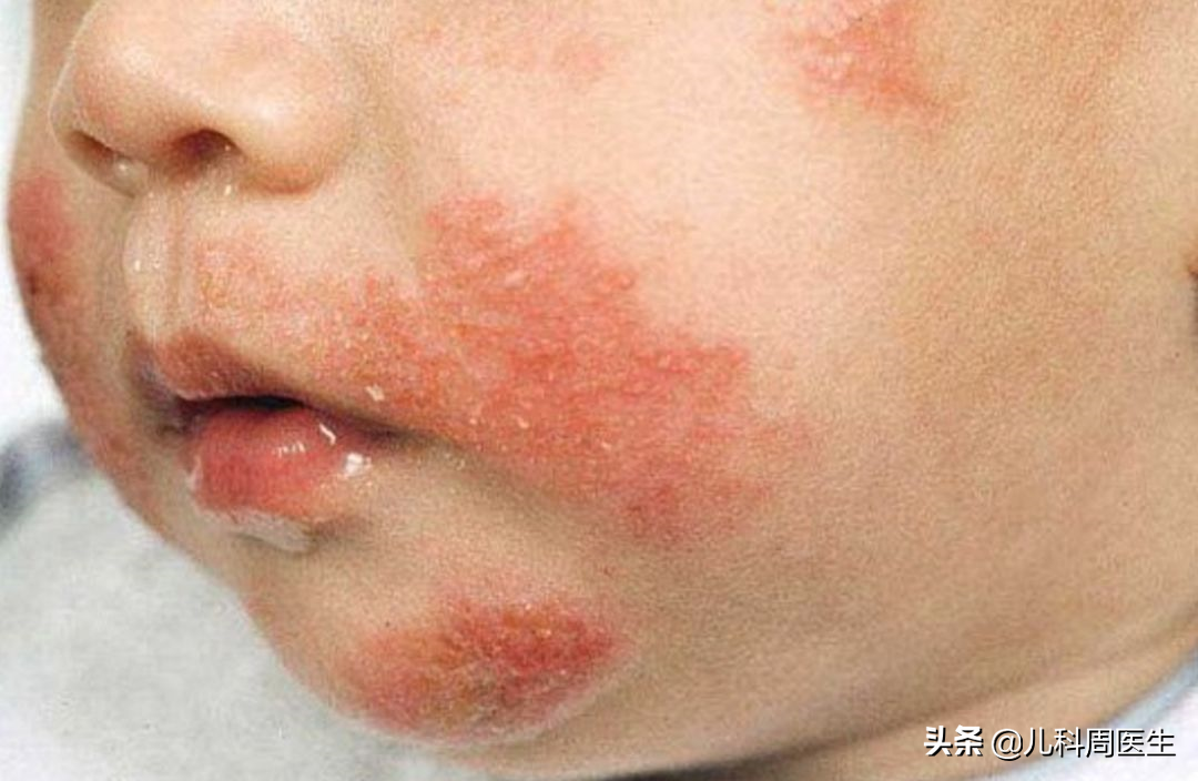 夏日长痱子,淹脖子,湿疹真假难辨?防护做得好,宝宝皮肤自然好