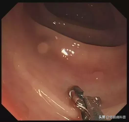 医生是怎样切掉肠息肉的?