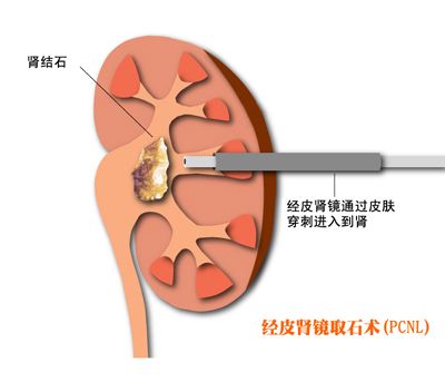 有一种病平时不疼，发作的时候比生孩子还疼，好发于年轻男性