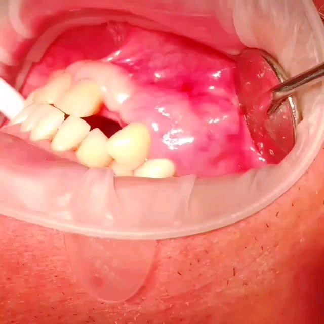 牙周脓肿很痛苦,六大预警你要注意!