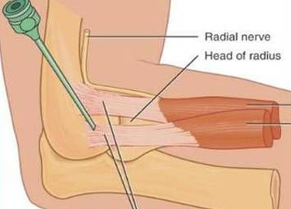胳膊疼痛咋回事？