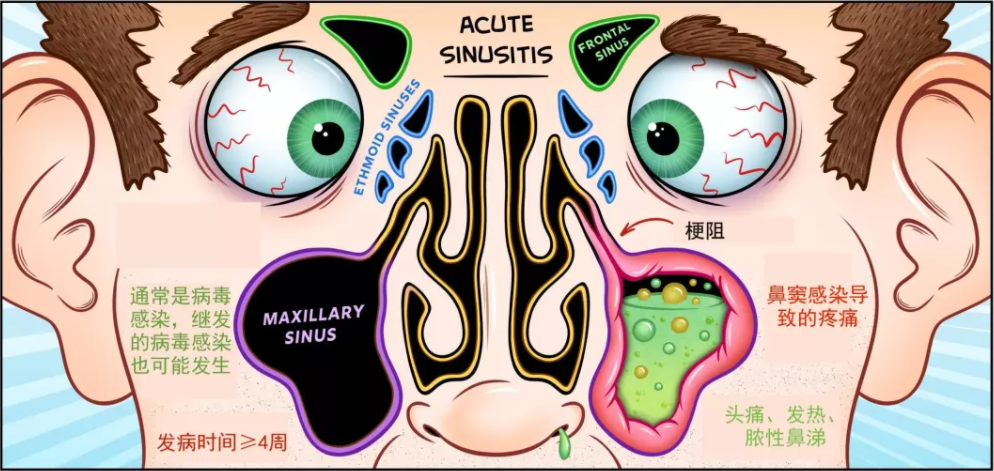 老教授离不开卫生纸，小伙子变成“金鱼眼”！从自行喷药到手术开刀，鼻窦炎咋治？