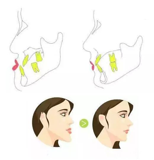 "地包天"不该成为困扰你的原因，矫正要趁早，完成后能直接变美