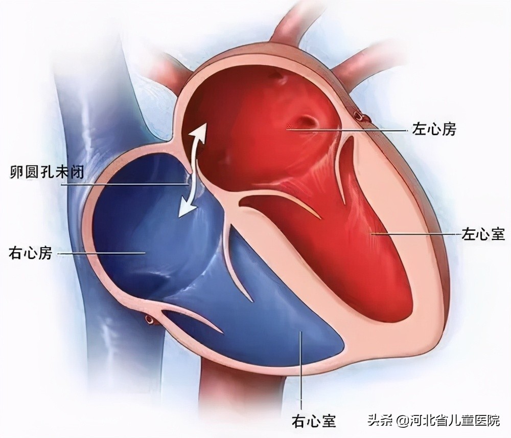 我都这么大了，卵圆孔还没闭合，怎么办？