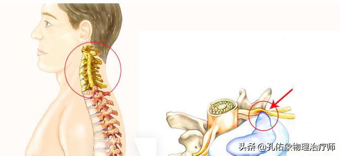 ①椎體的小關節紊亂小關節的紊亂,特別是頸椎的小關節和上胸椎的小