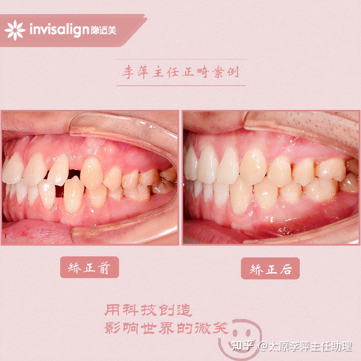 太原牙齿矫正：隐形牙套效果好不好？看这些病例你就知道了