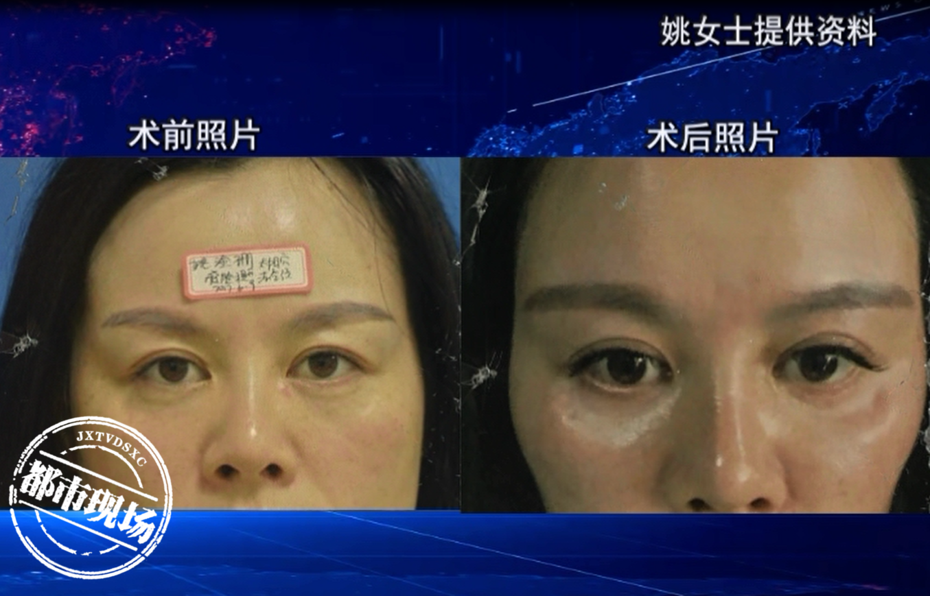 在宜春“华美”做眼部整形，2年修复4次，女子：越修复越差