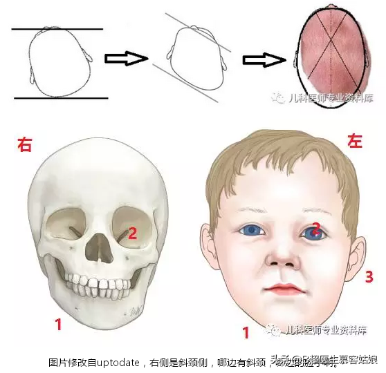 宝宝总是歪头，面向一侧，俗称“歪脖”，听说这叫斜颈，怎么办？