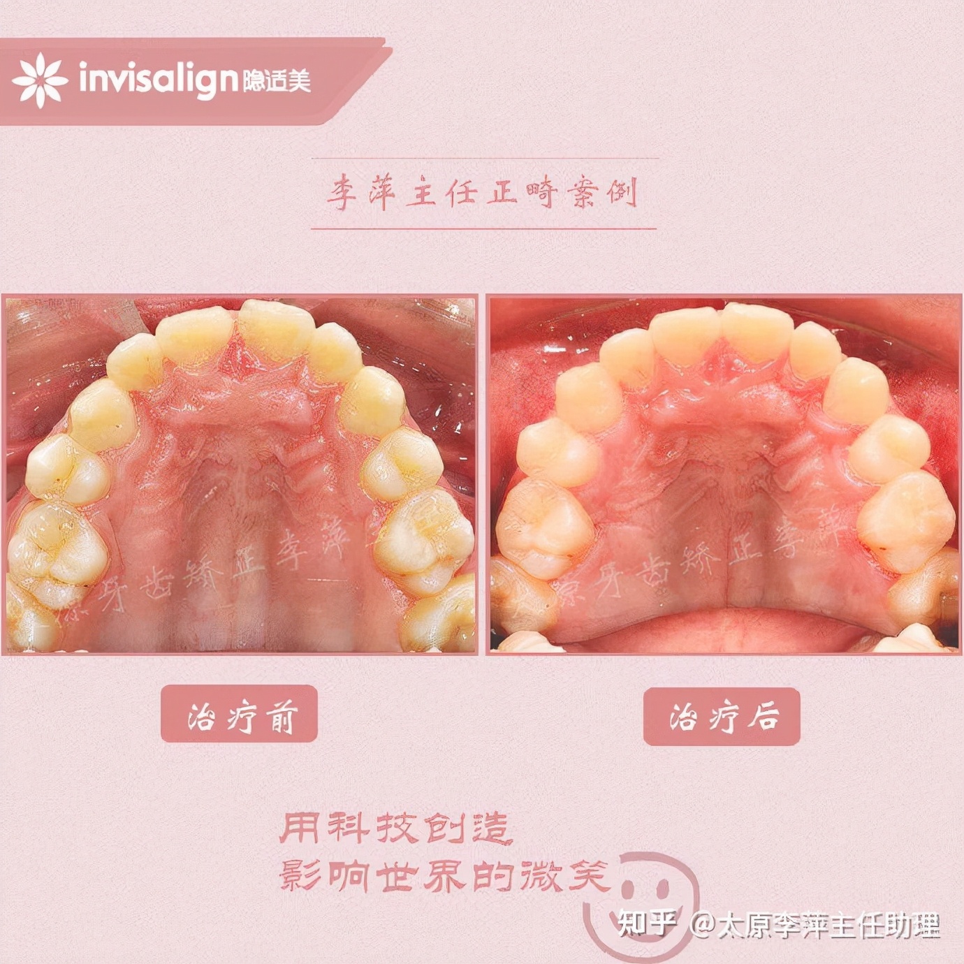 太原牙齿矫正：隐形牙套效果好不好？看这些病例你就知道了