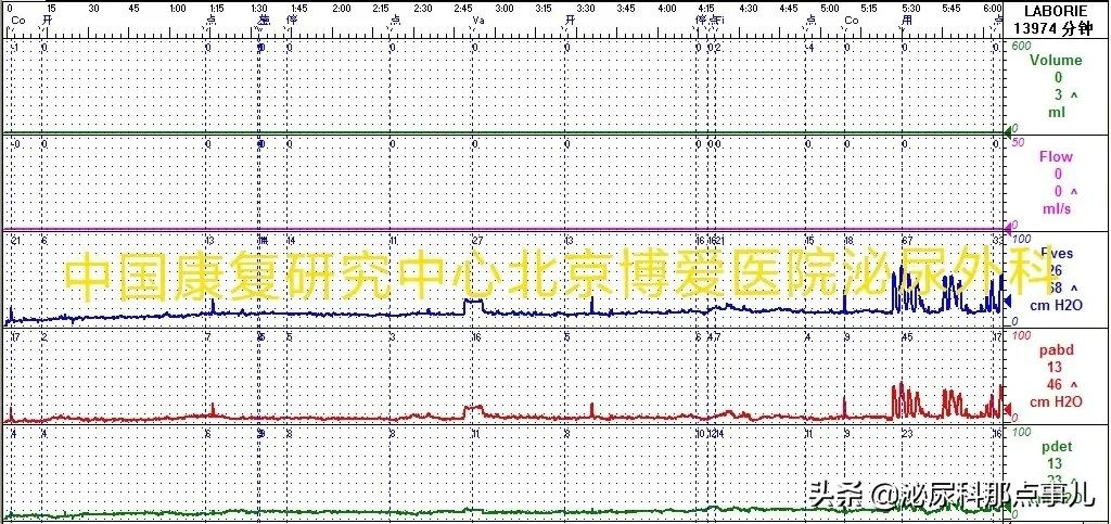 肠道膀胱扩大典型病例解析 | 神经源性下尿路功能障碍专栏 027