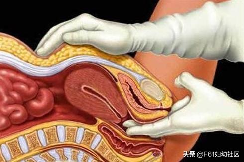 阴道斜隔及图片