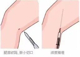 想要轻松享“瘦”就抽脂?抽脂前,一定要清楚这5个问题