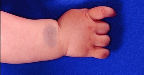 很多人“手臂中间有颗痣”，其实是胎记痣，可能在胎儿期就已注定