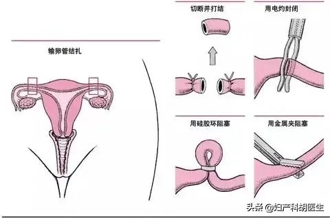 o型环在子宫里的图片图片