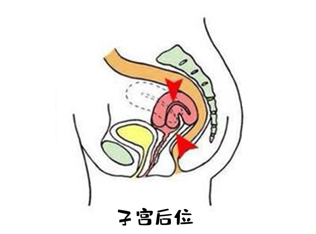 怀孕子宫什么样子图片(不孕可能是位置不对) - 赤虎壹号