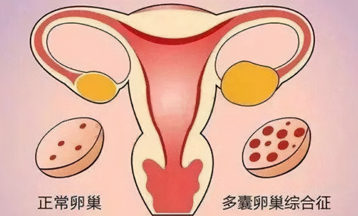 女子结婚5年没怀孕，被丈夫带去医院检查，查出是多囊卵巢综合征