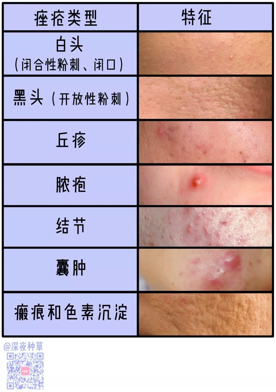 痘坑类型图片