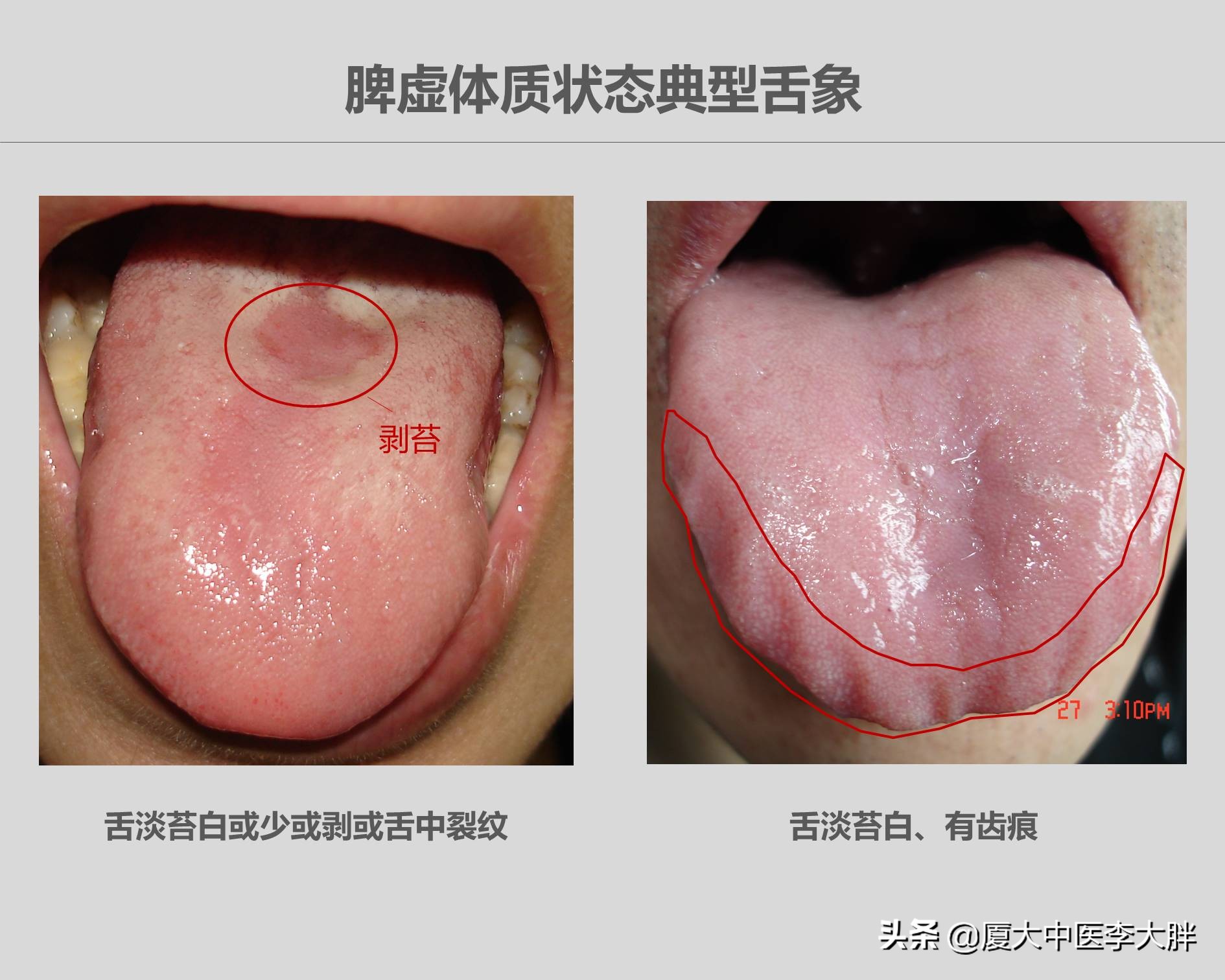 胃癌早期舌头图片(舌头长这样的人要十分警惕) - 赤虎壹号