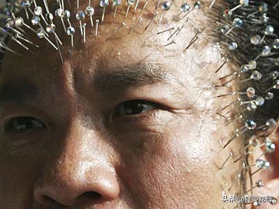 头针是不是扎脑神经?它是如何发挥疗效的?治疗效果如何?