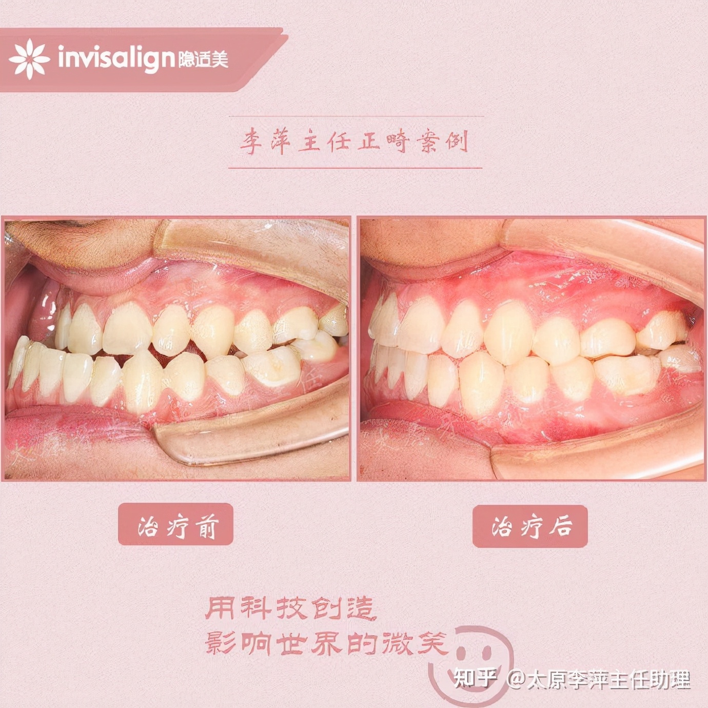 太原牙齿矫正：隐形牙套效果好不好？看这些病例你就知道了