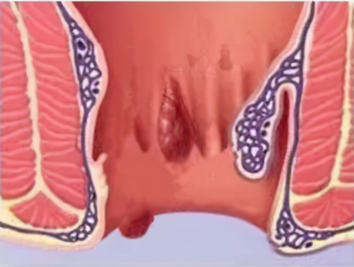 痔疮外痔图片长什么样(杨大夫带你揭开血栓性外痔的前世今生) - 赤虎