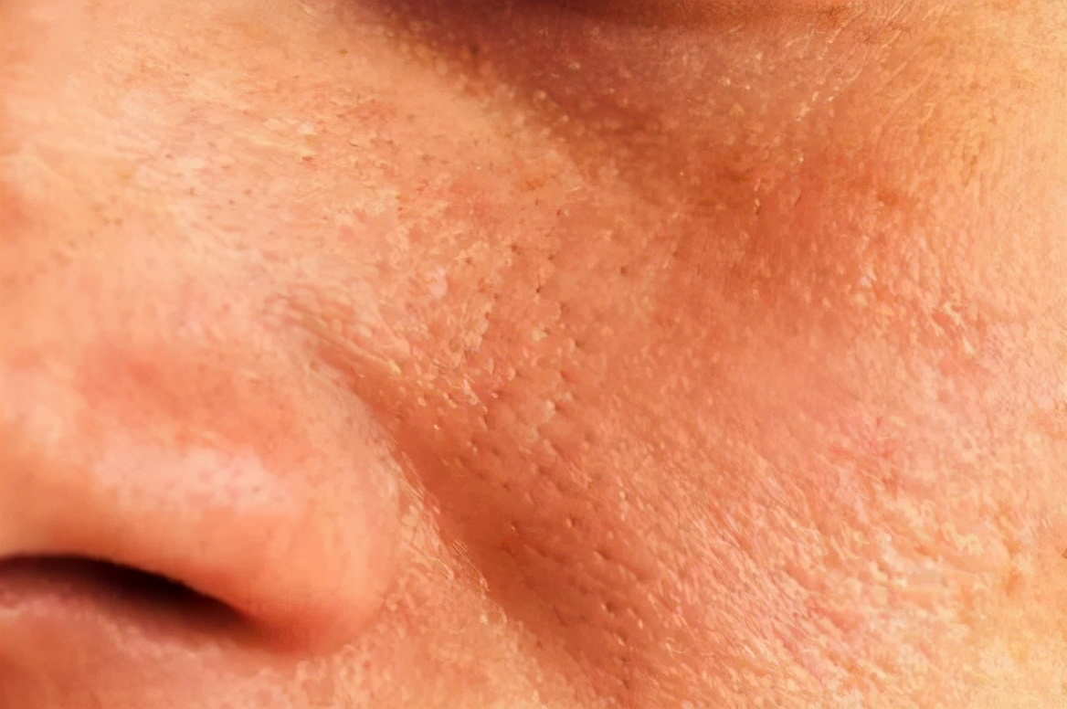 油痘肌，黑头，闭口几乎占全有合适的护肤品推荐吗？