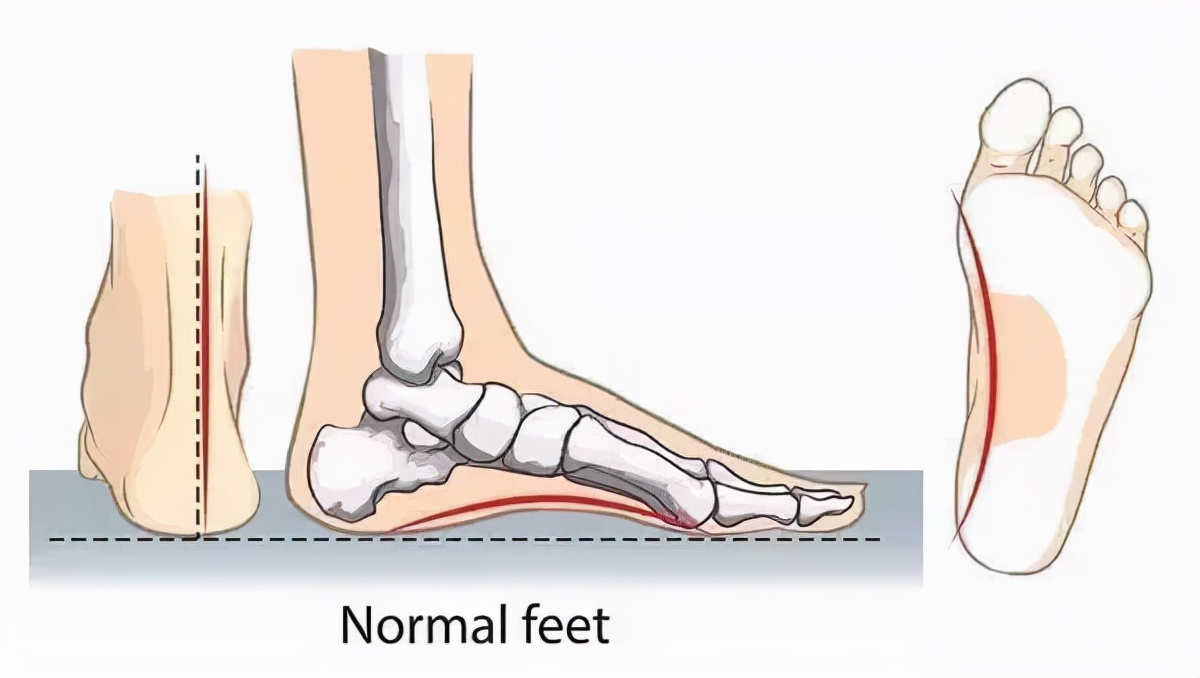 人到中年，足弓就渐渐“塌”了！一个脚印看出足弓高低