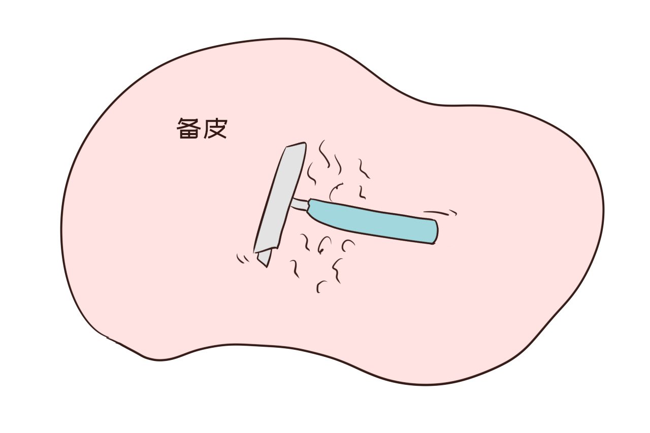 剖腹产备皮范围图片