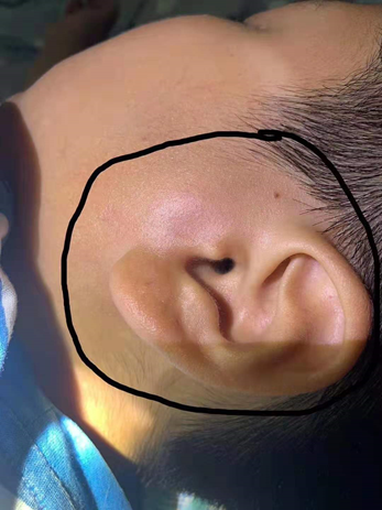 你知道吗？细菌性腮腺炎，还可以这么治