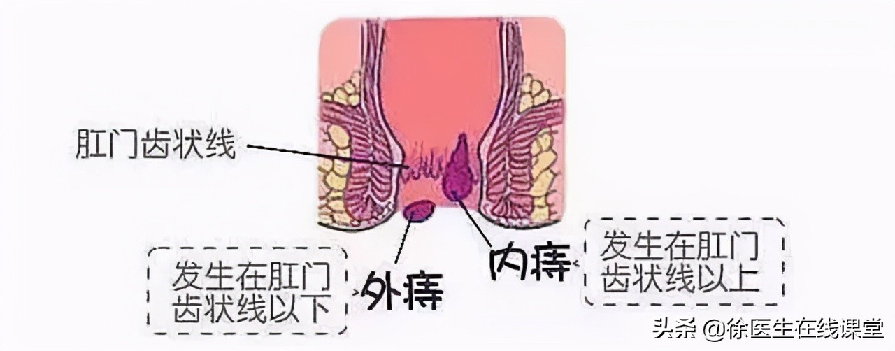 肛门边的肉球，除了痔疮，还可能是什么，需要治疗吗？