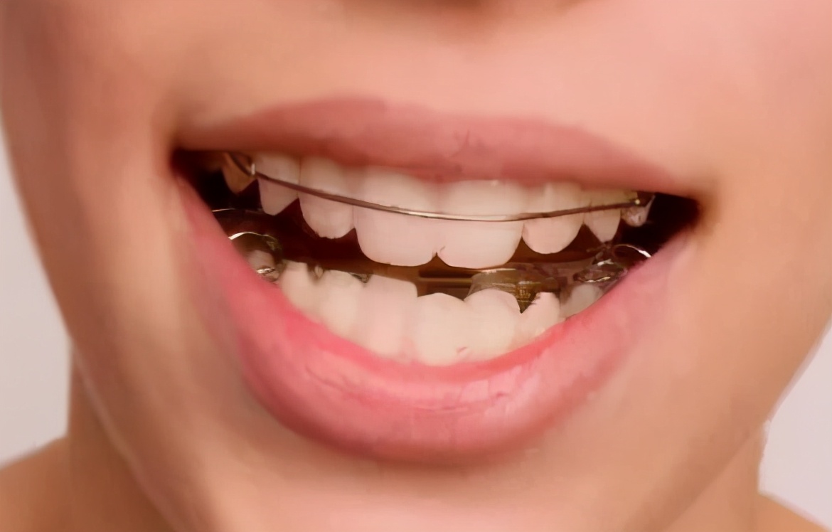 儿童牙齿矫正器 箍牙图片