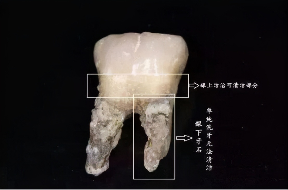 洗个牙要2000+ 不是说洗牙很便宜的吗？我这是被坑了吗？