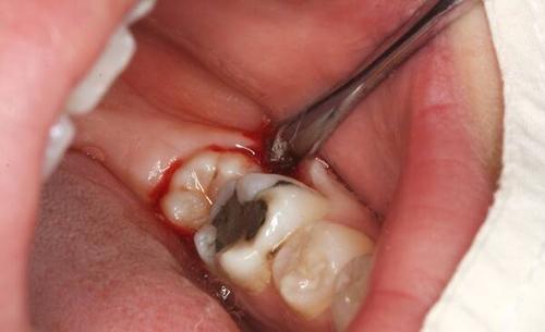 拔完牙干槽症的图片图片